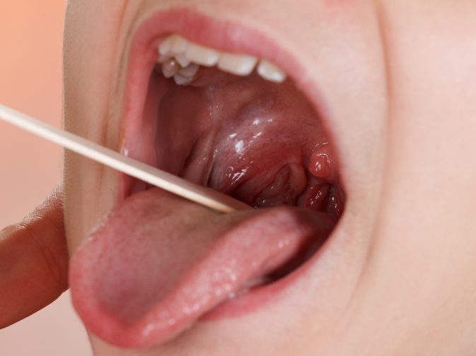 3 måder at helbrede kronisk kryptisk tonsillitis