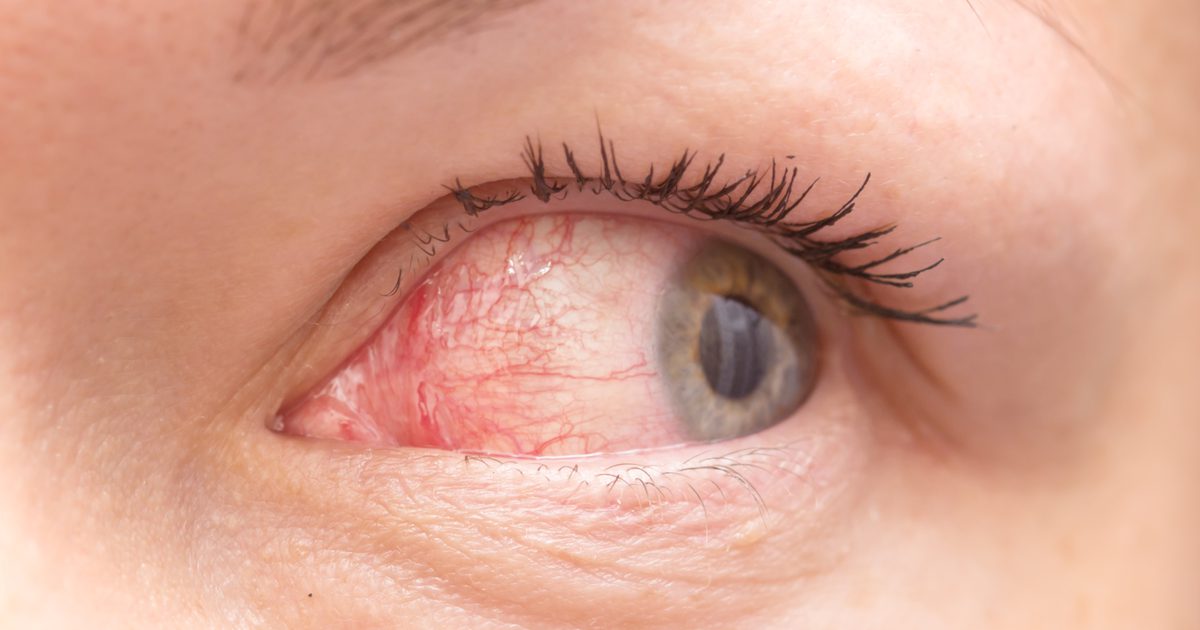 3 способа предотвратить распространение розового глаза