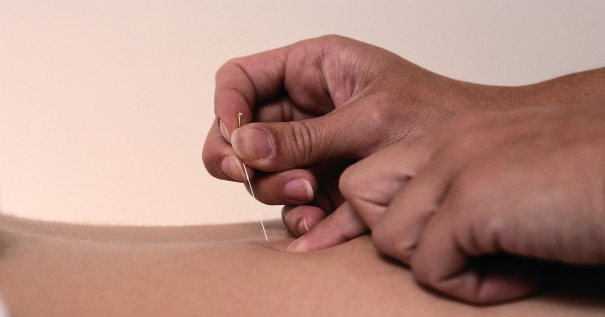 4 Möglichkeiten, Psoriasis mit Akupunktur zu behandeln