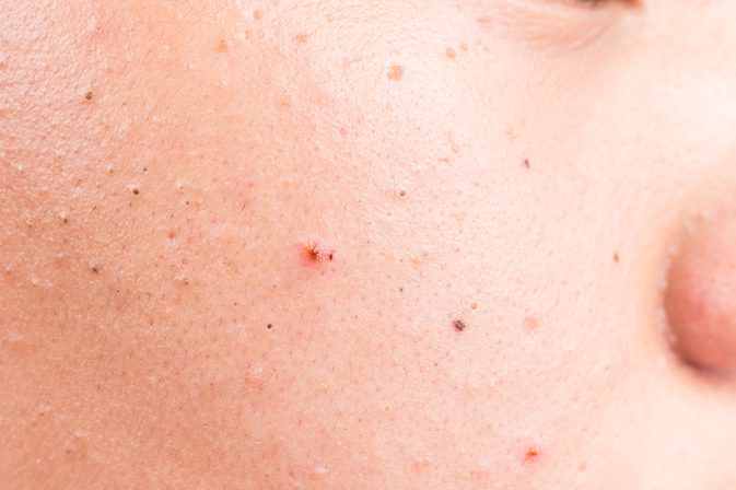 5 ting du bør vite om isotretinoin for acne
