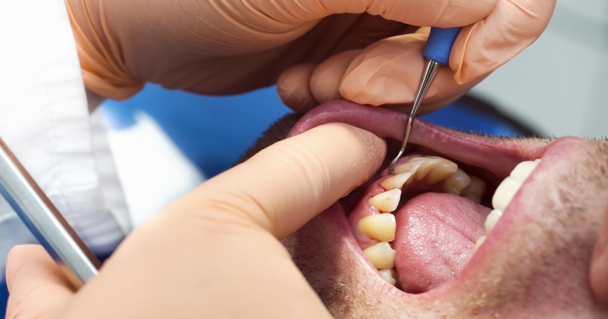 Abcess zobne faze