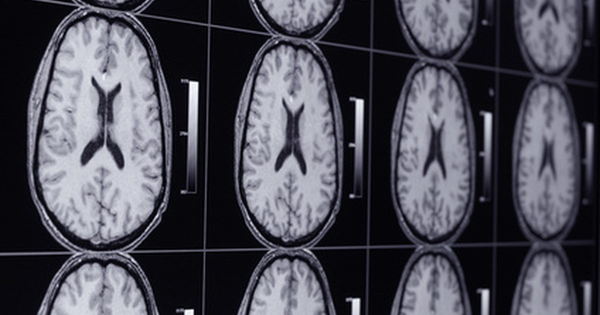 Abnormale Brain MRI-resultaten
