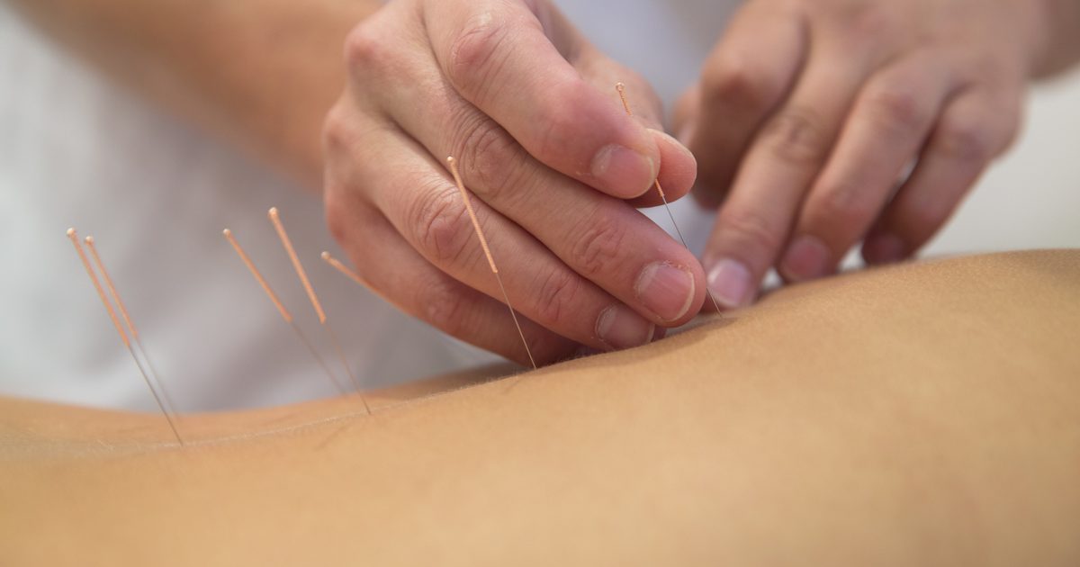 Akupunktur och inre menisk riva