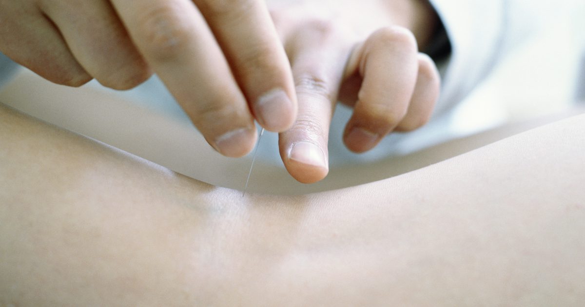 Akupunktúra pre kyslý reflux