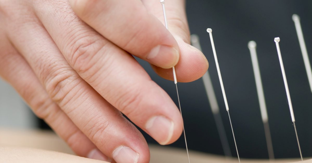 Akupunktur for balance og svimmelhed