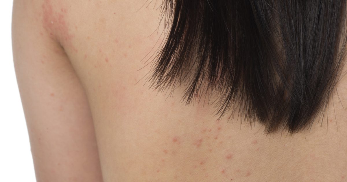 Er røde flekker på huden en glutenallergi?