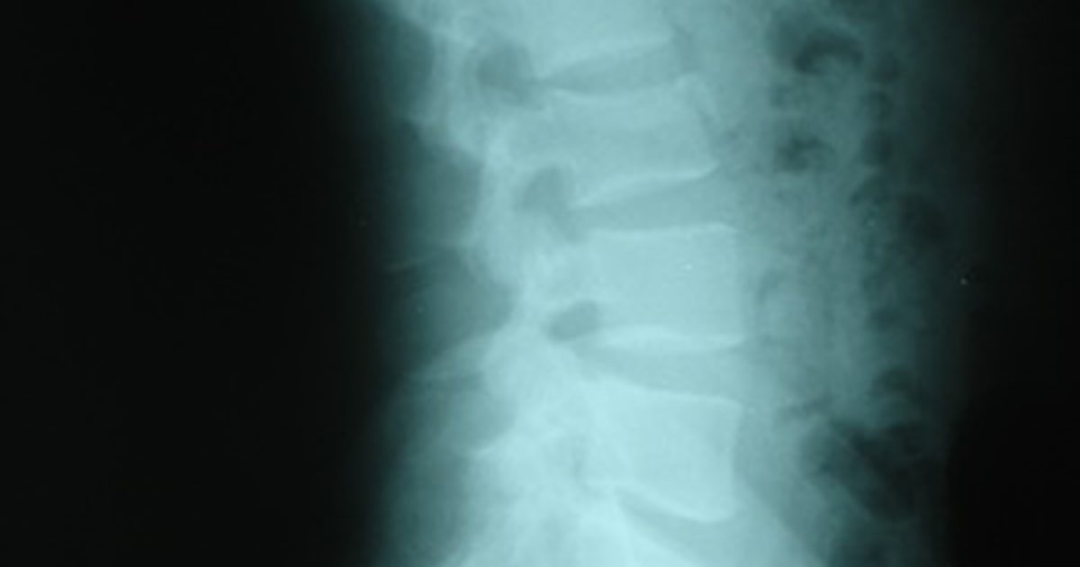 Darm- und Blasenkomplikationen einer Bandscheibenvorfall-Bandscheibe