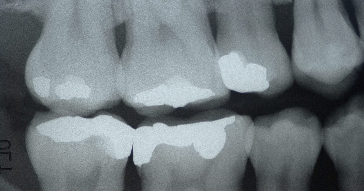 Всасывание кальция и распад зуба
