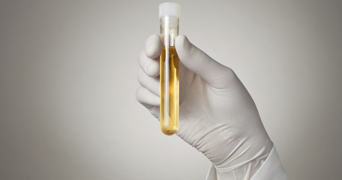 Komponente analize urina