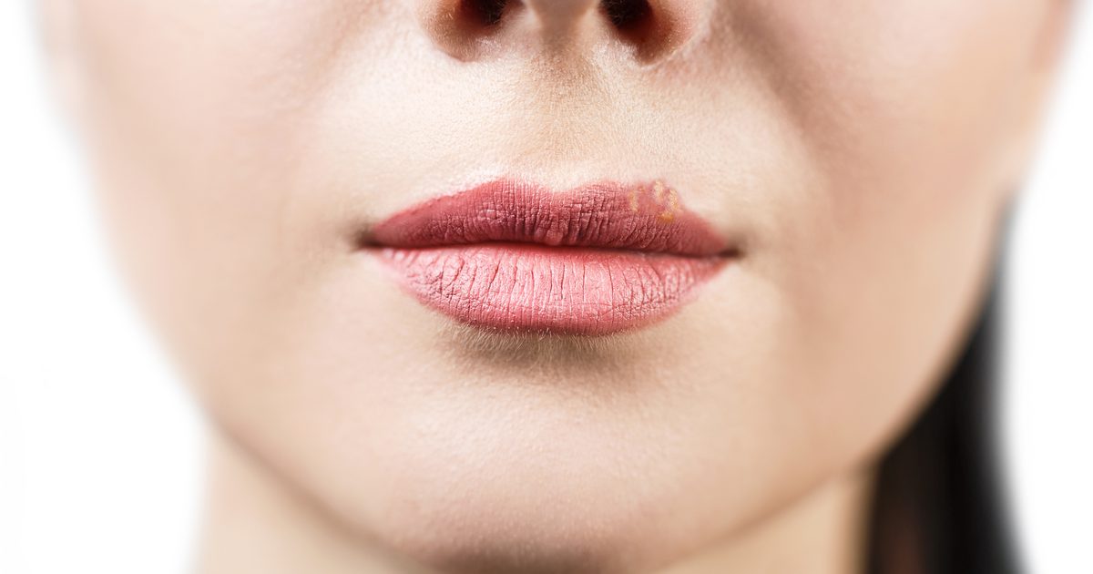 Unterschiede zwischen Lippenherpes und Herpes