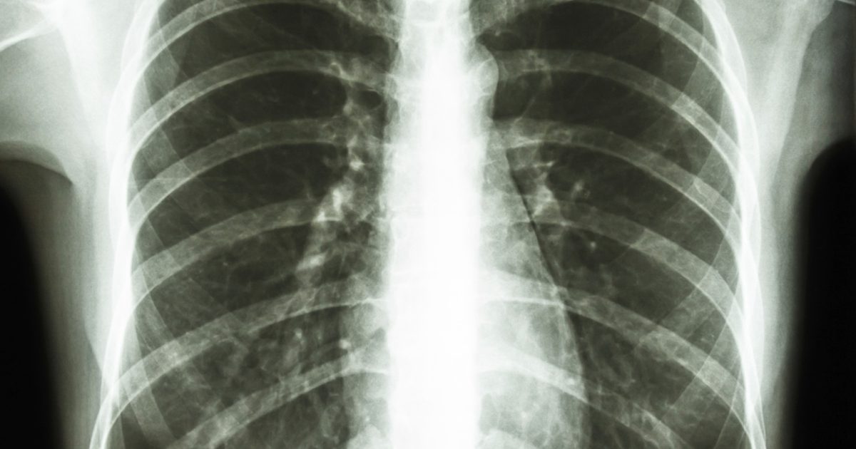 Sjukdomar som orsakar nudlar att bilda på lungorna