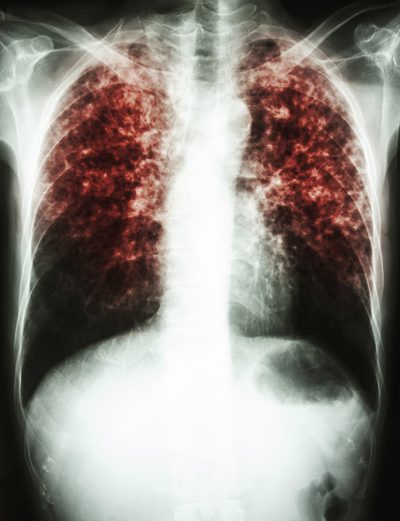 Effekter från tuberkulos