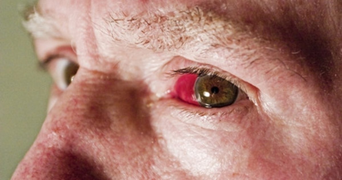 Øjneforstyrrelser, der forårsager rødme i øjets hjørne
