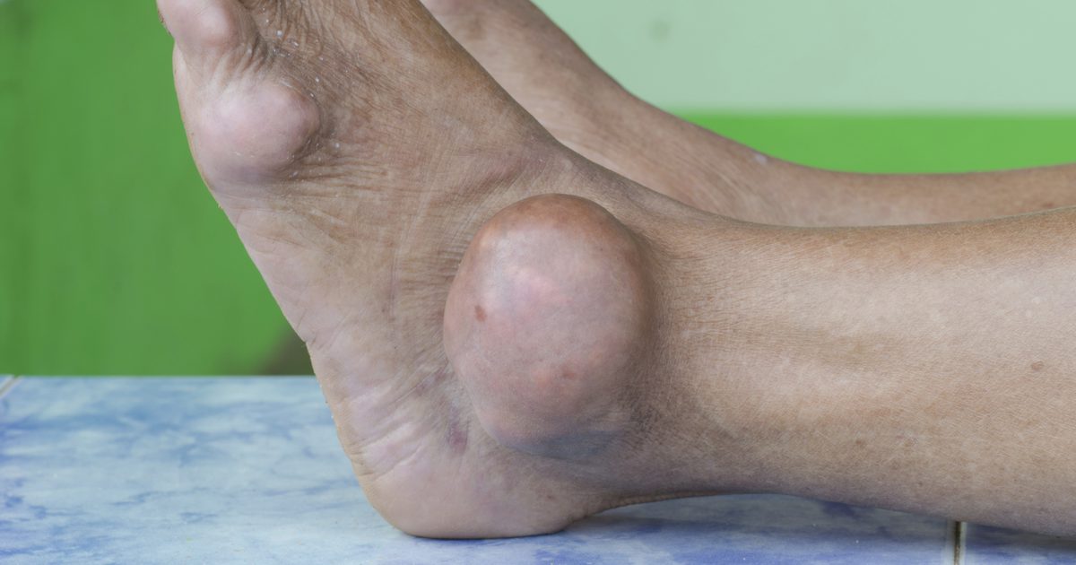 Hjem Remedies for Gout Flare Ups