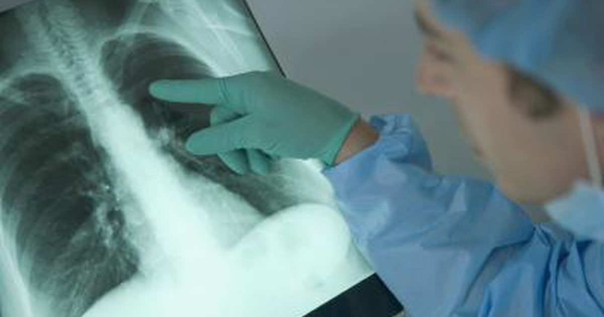 Kako rak pljuč vpliva na vaše telo?