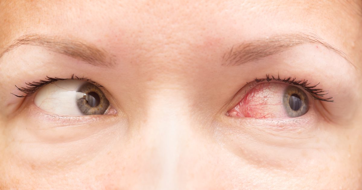 Как спите с контакти причиняват розово око