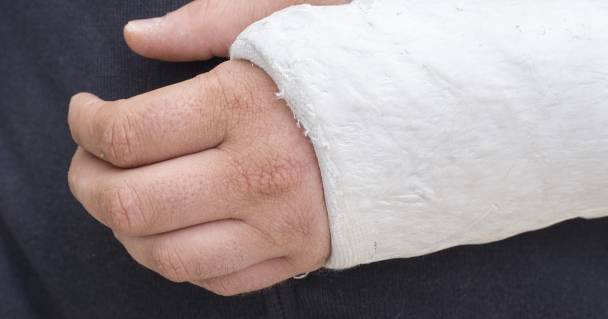 Sådan fjerner du smerte fra en brudt arm