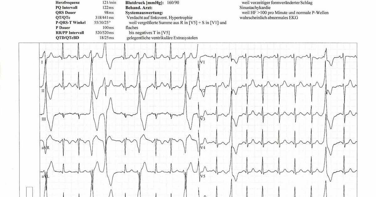 Hur man läser en onormal EKG
