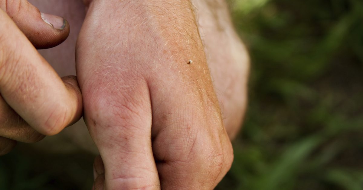 Sådan fjerner du en Bee Stinger fra huden