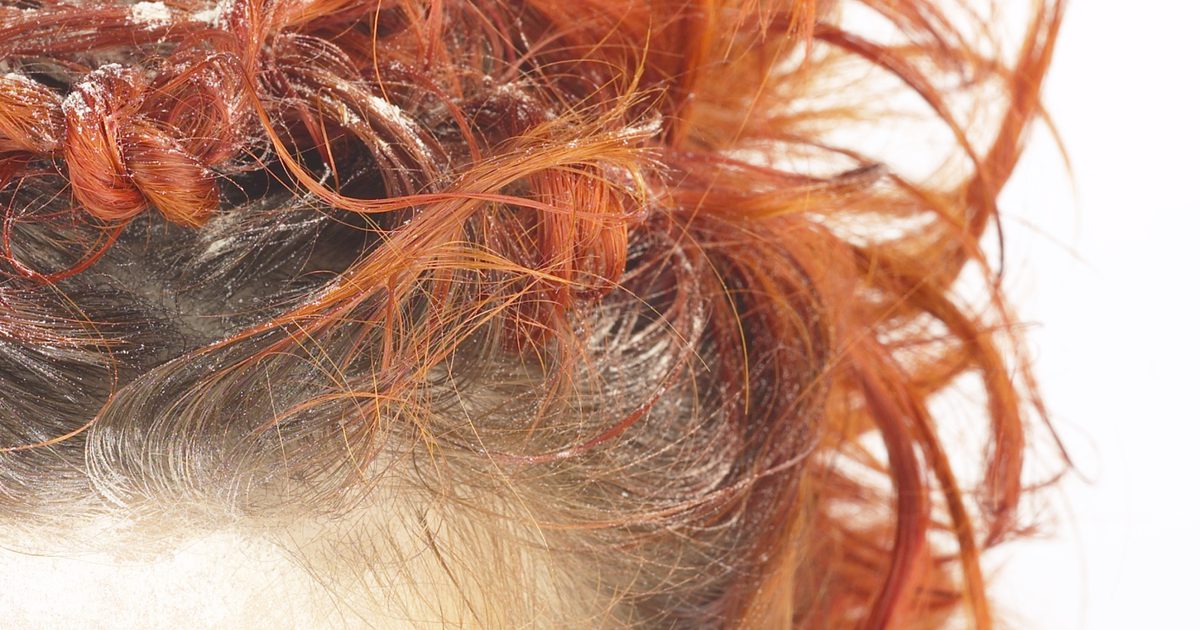 Как да се пребори с пърхота в цвят на косата