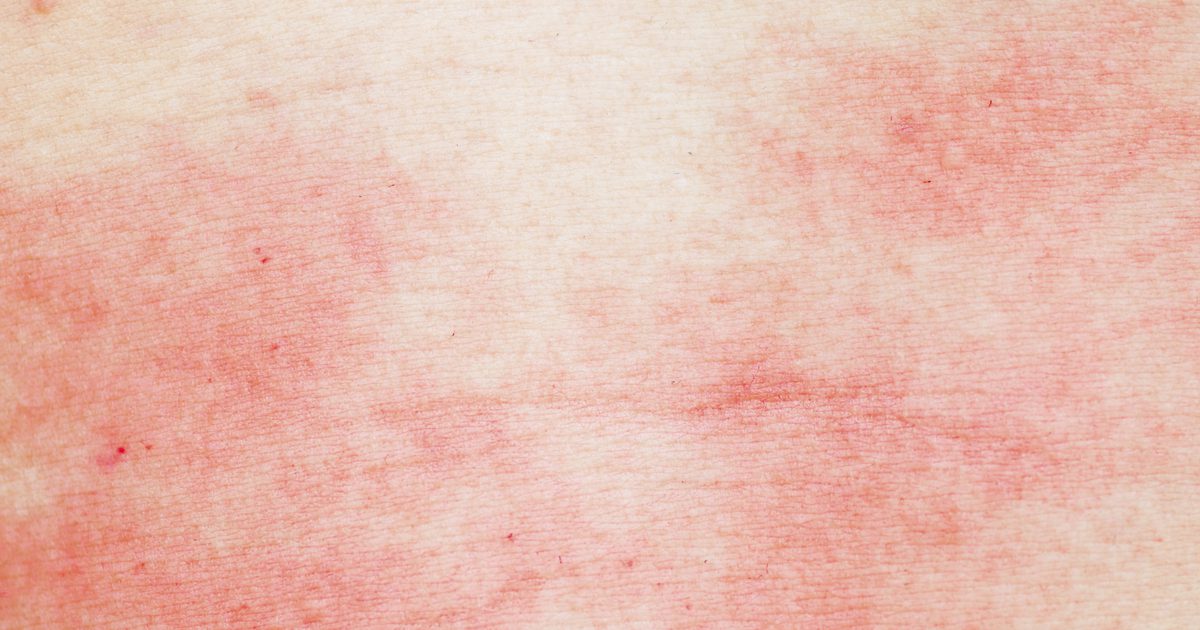 Itch Relief for Hives