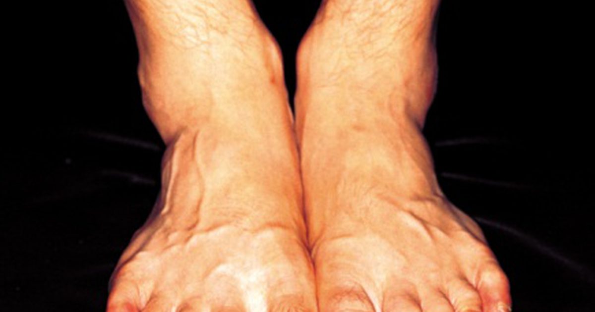 Swędzące stopy podczas ćwiczeń