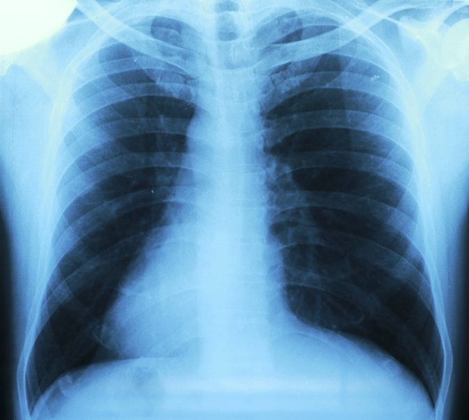 مشاكل الرئة التي تسبب آلام الصدر