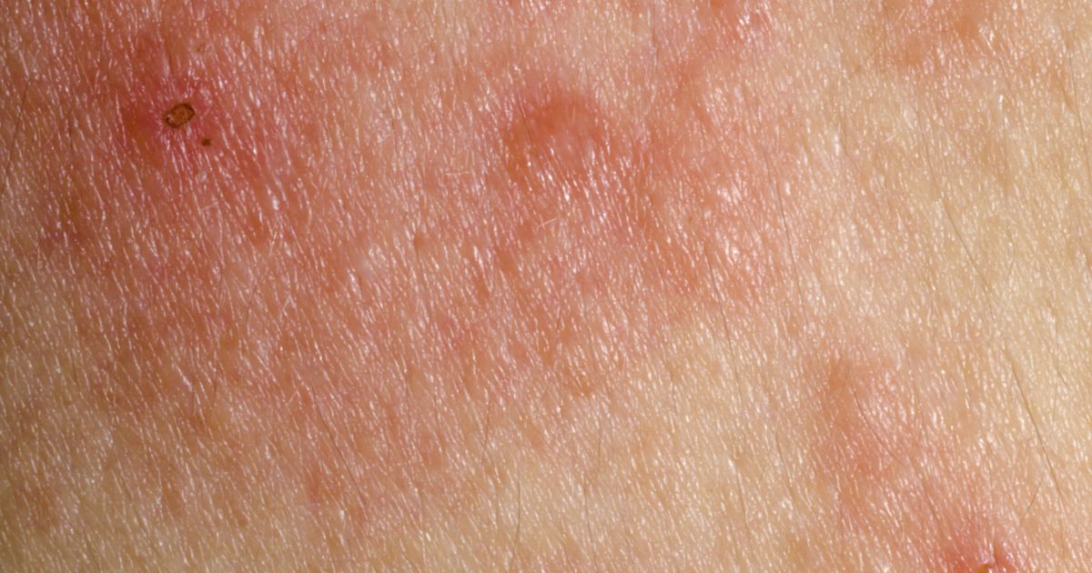 Over Counter Behandlinger for Skin Rash
