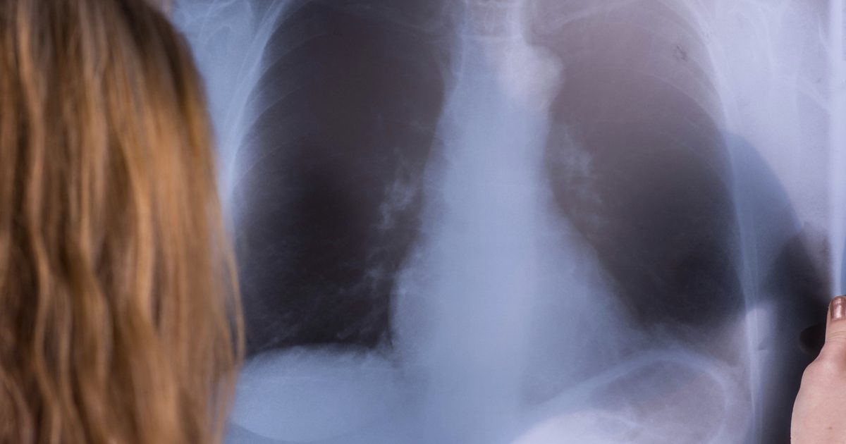 Bukspyttkjertelkreft og væske buildup i lungene