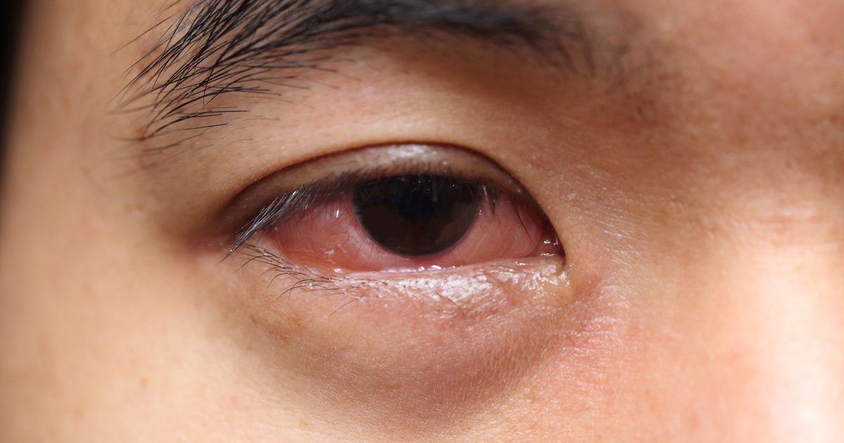 Šialená a svrbivá tvár z alergií