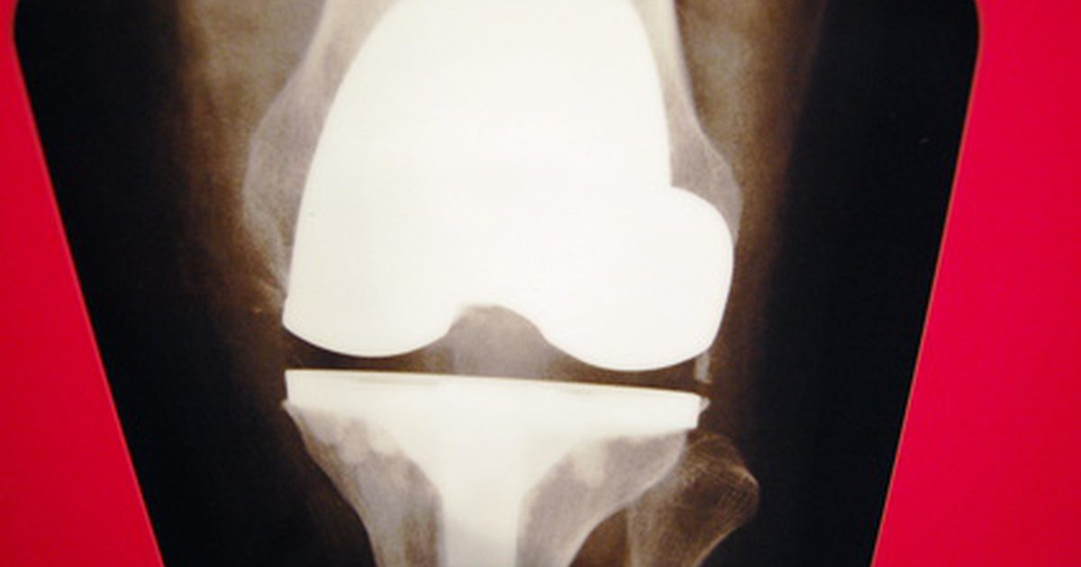 Środki na obrzęk nóg po operacji wymiany stawu kolanowego