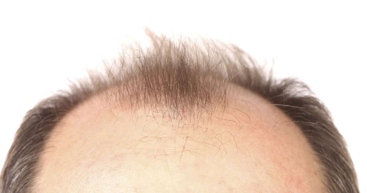 Retin-A Hair Loss Behandlinger