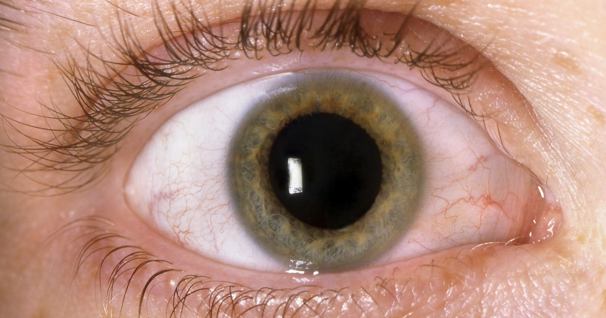 Biverkningar av över att använda röda ögondroppar