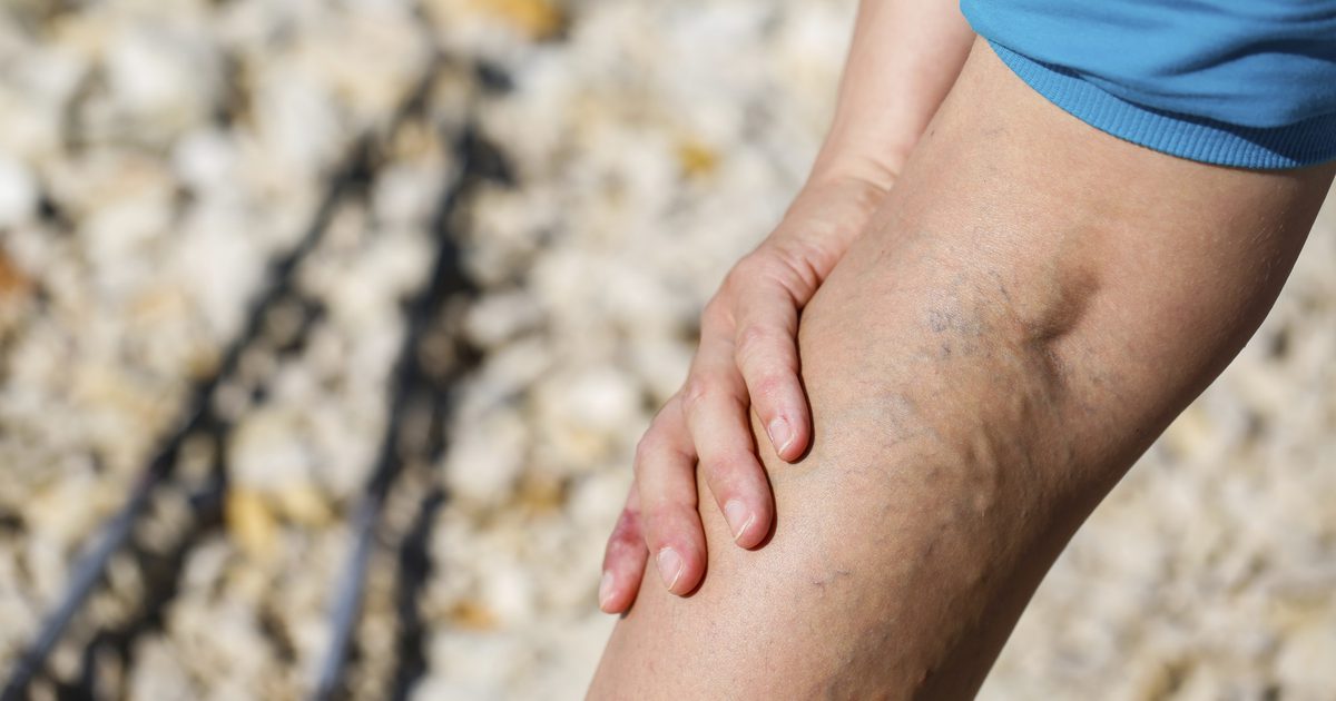 Tecken och symptom på vaskulära problem i benen
