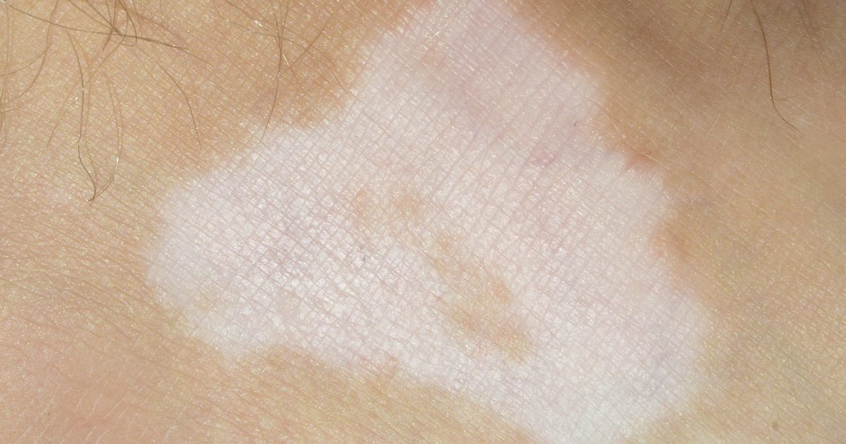 Zaburzenia skóry, które powodują utratę pigmentu