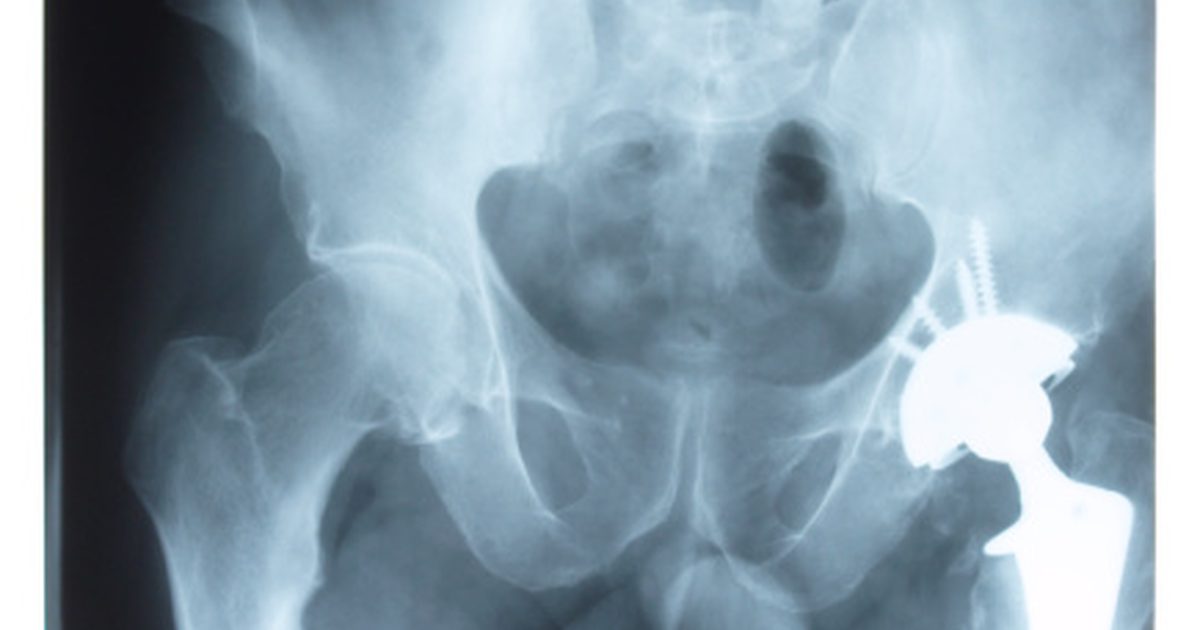 Stretching & Contraindications for Hip Replacement