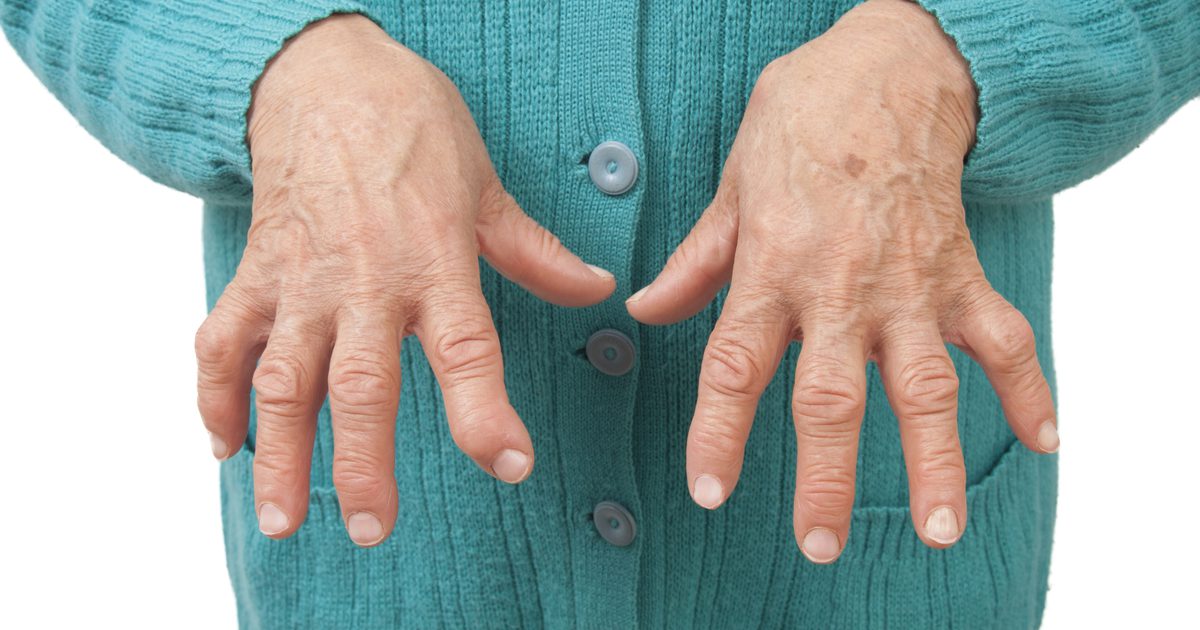 Symptomer på Lupus Vs. Rheumatoid arthritis