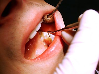 Zahnschmerzen nach einer Zahnreinigung