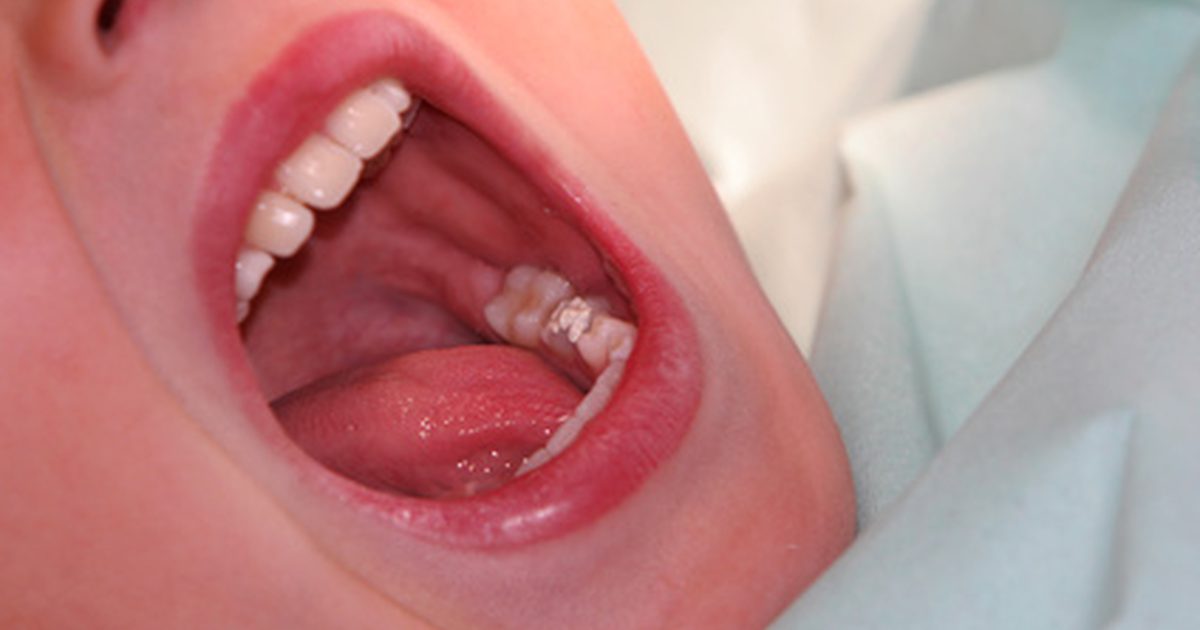 Обезболяващи зъби с пероксид