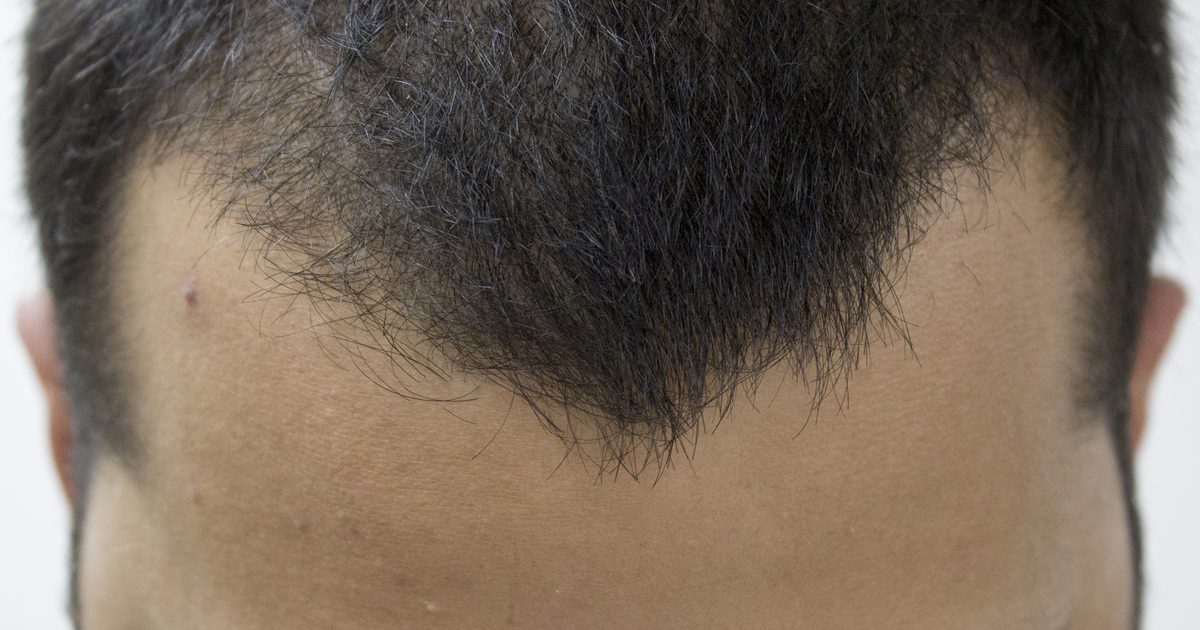 Top 10 der besten Haarausfall Behandlungen