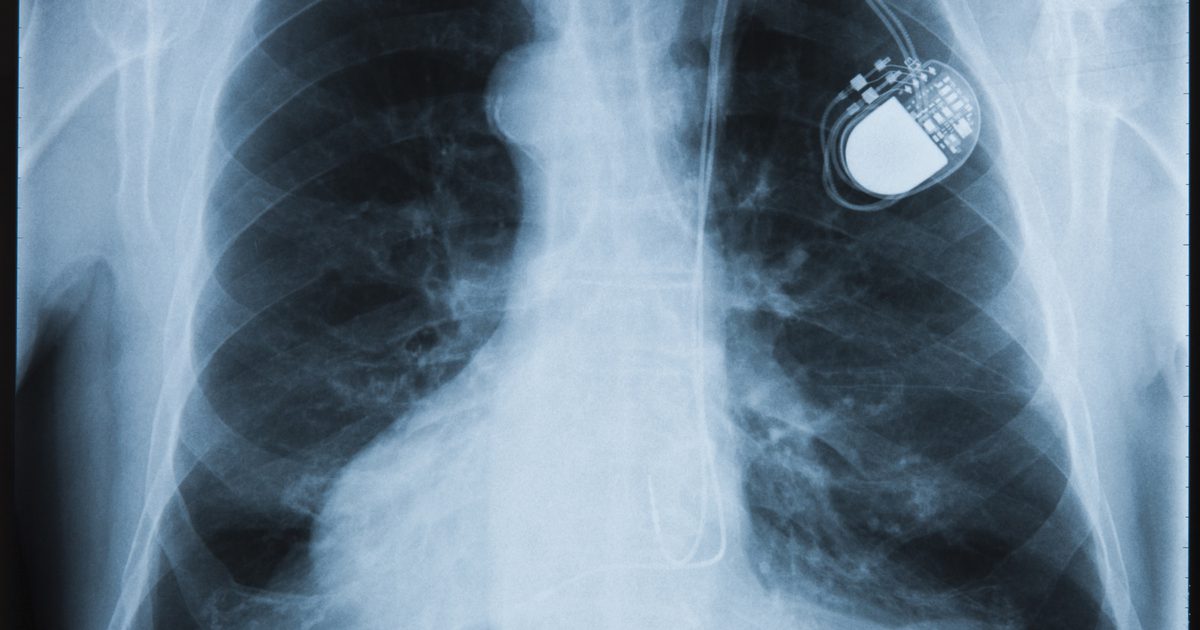 Hva er fordelene med en pacemaker?