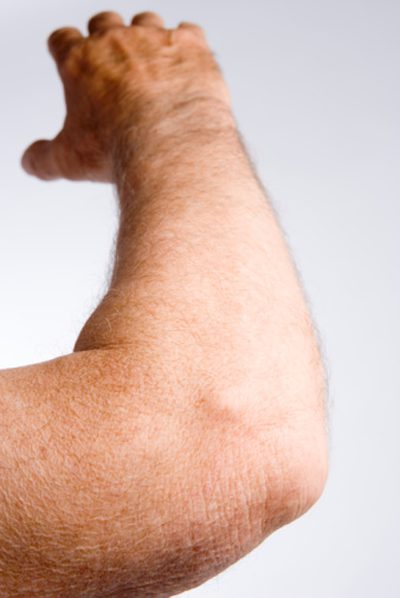 Vad är orsakerna till bilateral armbåge smärta?