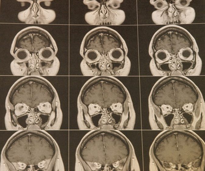 मस्तिष्क एट्रोफी के कारण क्या हैं?