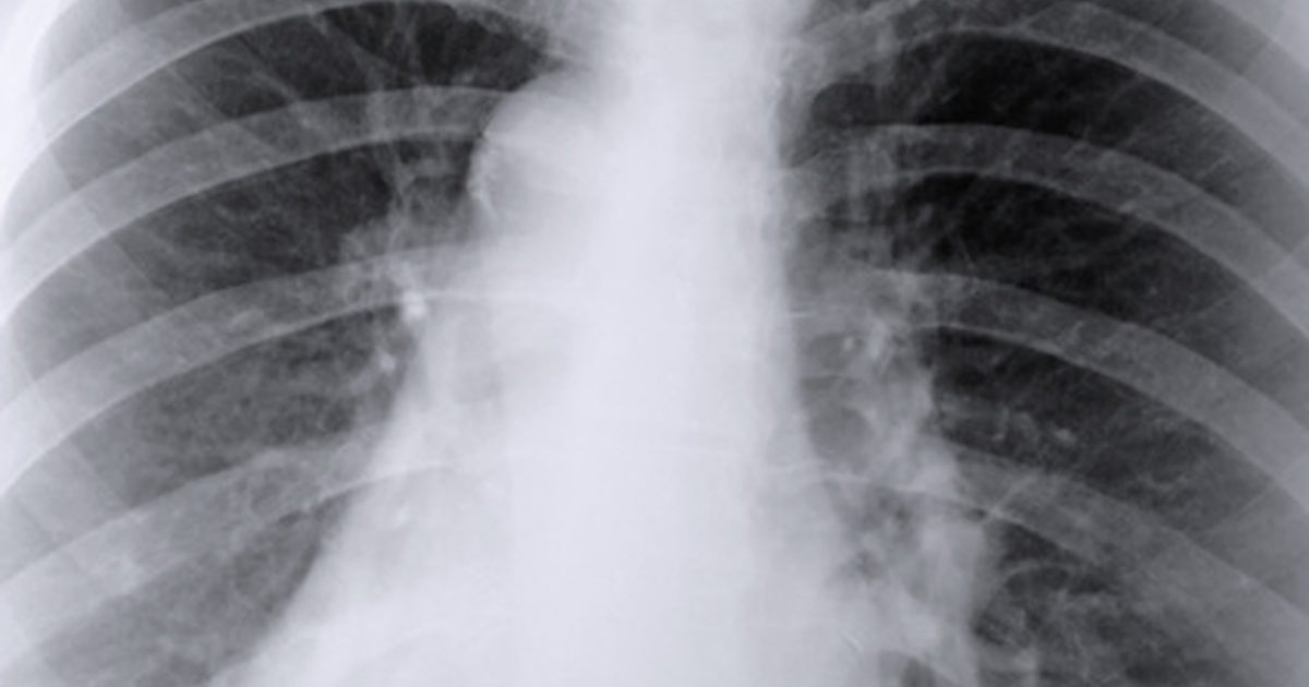 Kateri so vzroki infiltracije pljuč?