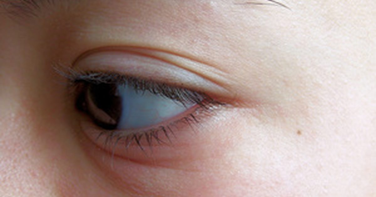 Hvad er årsagerne til et ømt hævet øjenlåg?