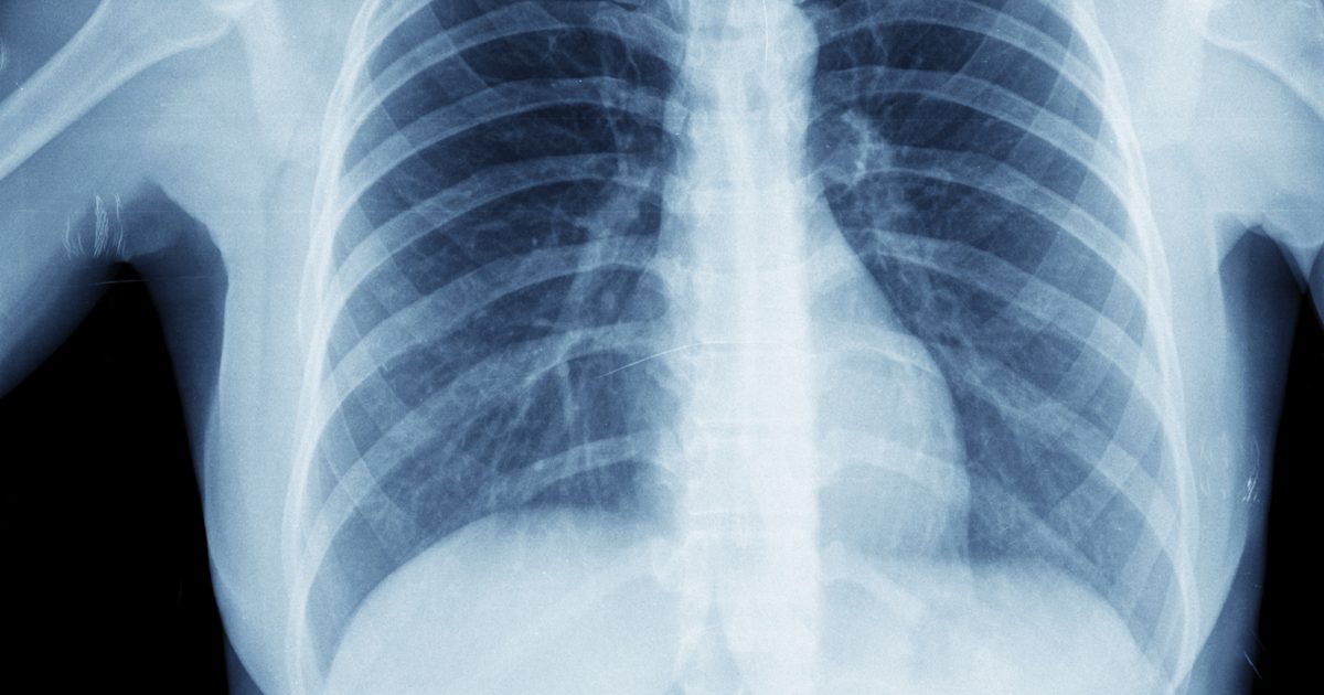 Vad är lunginflammationskomplikationer?