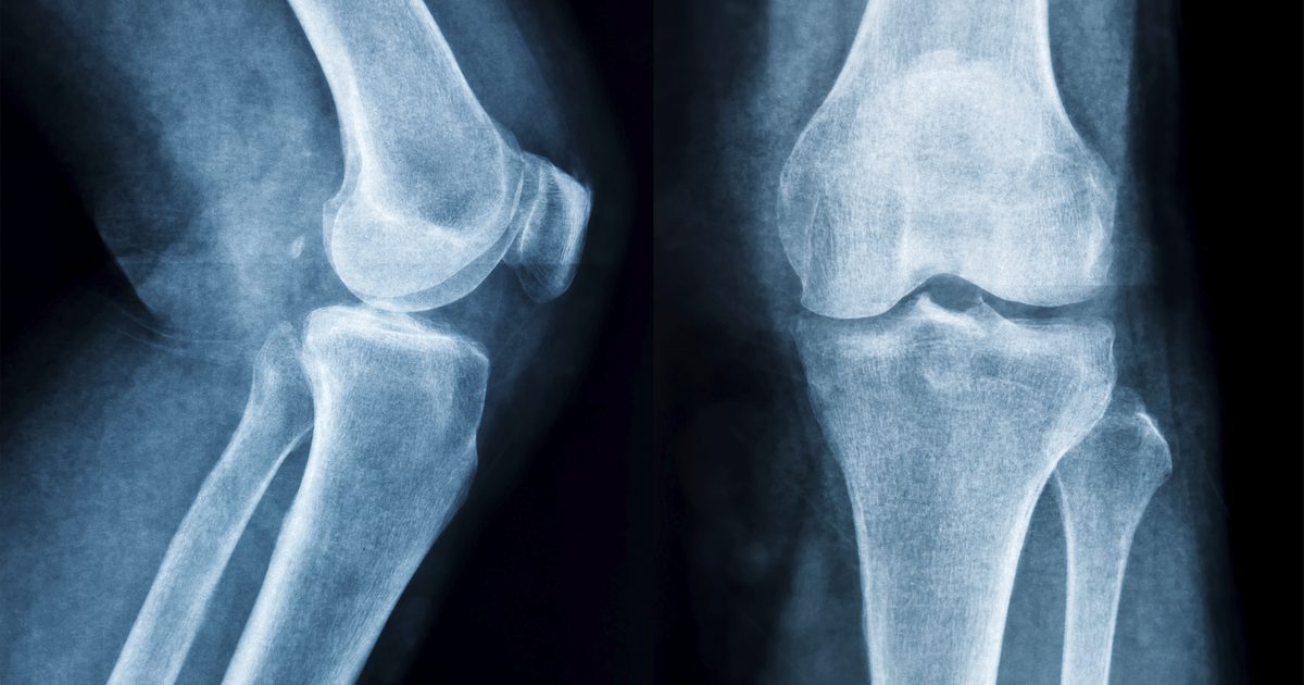 Wat zijn de behandelingen voor botsporen op het beenbeen?