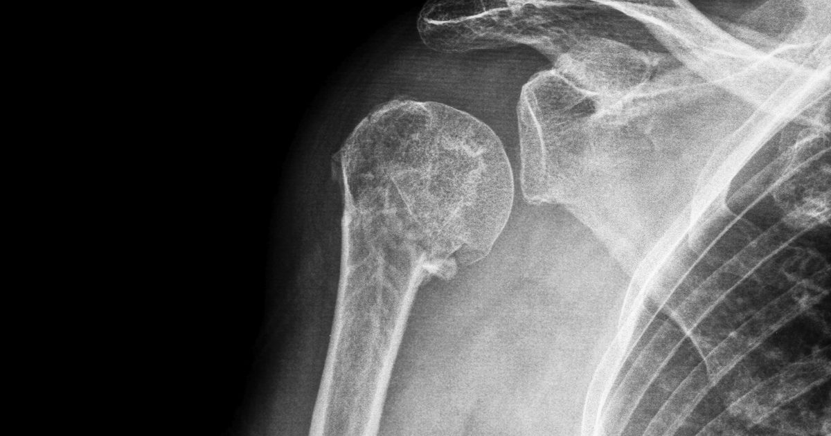 Hva er behandlinger for en knust skulder?
