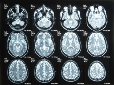 Kaj povzroča depozite kalcija na možganih?