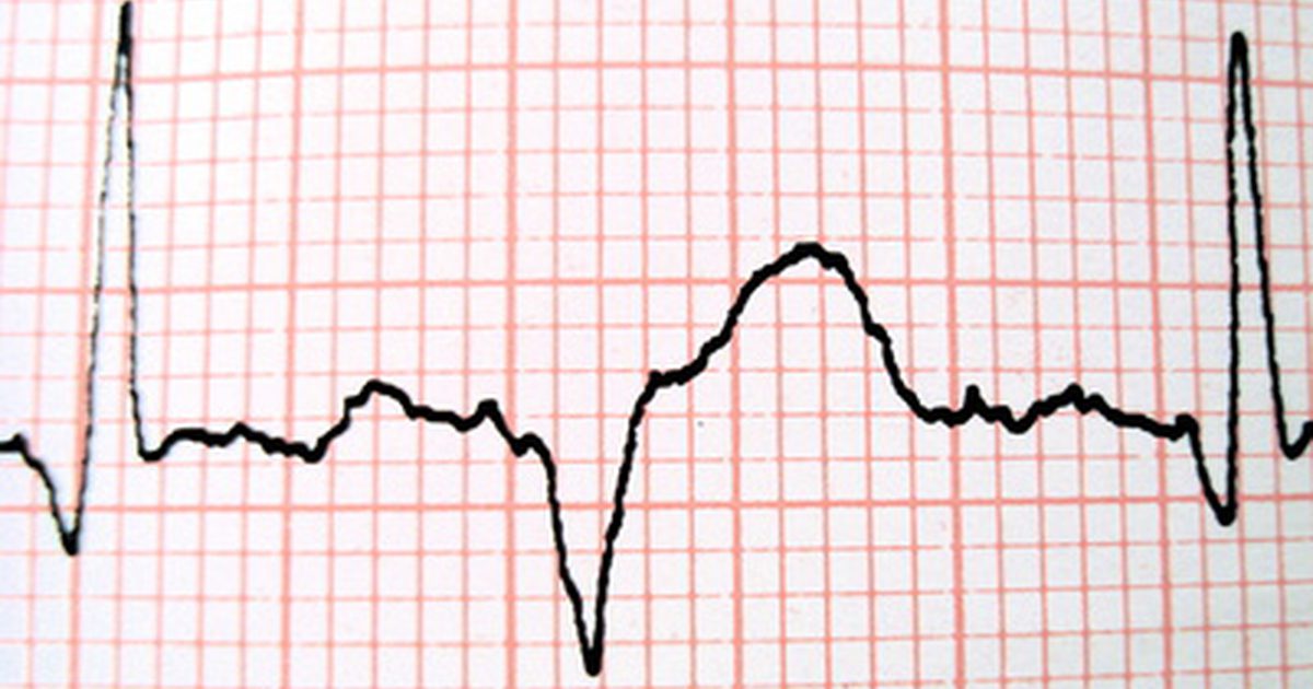 Hvad forårsager hjertebanken under graviditeten?